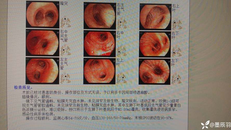 兴国县现有无症状感染者6例:兴国县疑似病例