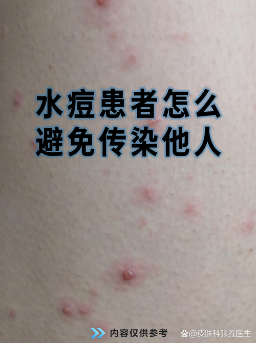 31省新增无症状感染者29例均在甘肃省天水市清水县:天水出现无症状感染者
