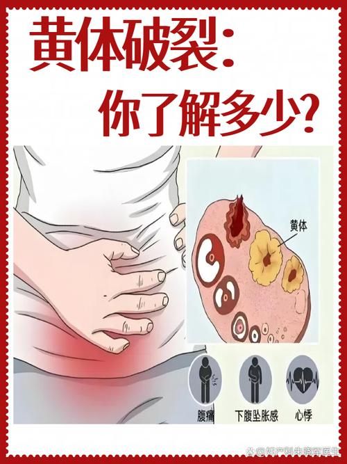 黄体破裂是什么意思-黄体破裂是什么意思2026业务讲解V.61.42.23.24